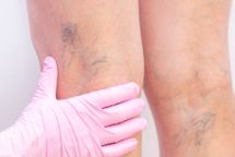 Secagem de Microvasos.jpg